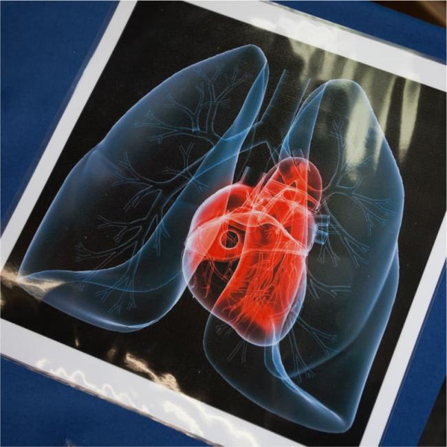 Orgaantransplantatie